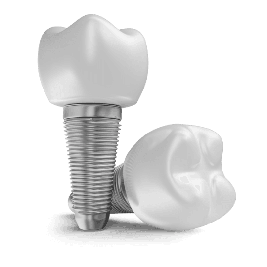 Implantes dentários em Nova Lima, Campo Grande MS